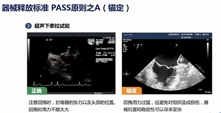 付华教授:经食管超声心动图指导左心耳封堵术的优势及操作要点分享